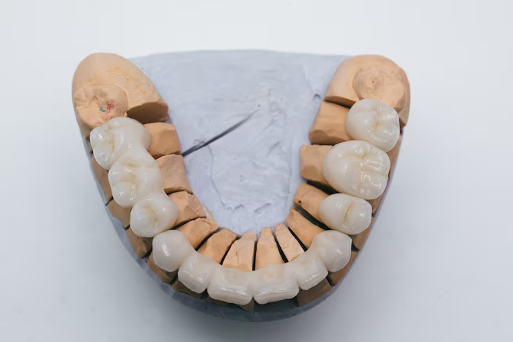 Learn from Dentist in Davie How Long Do Porcelain Crowns Last