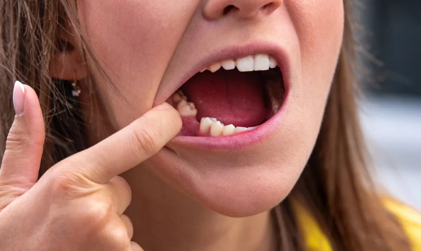 Replacing Missing Teeth