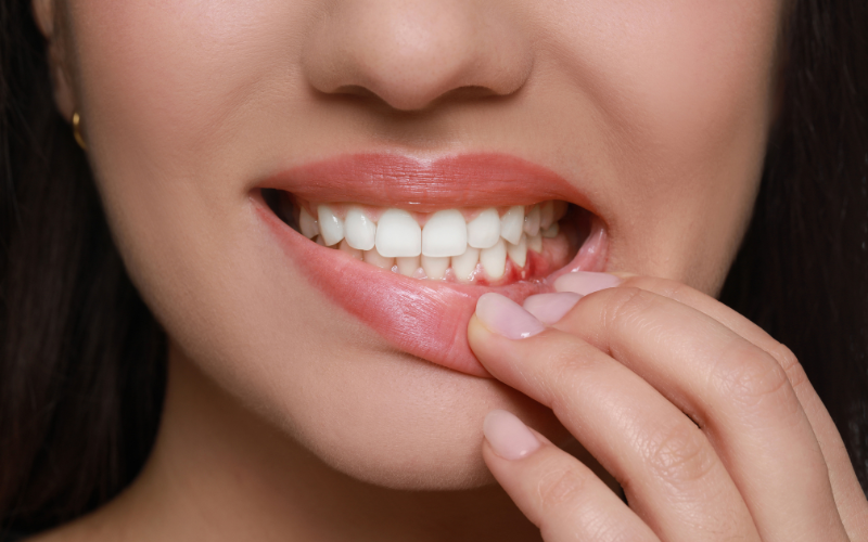 Gum Therapy for Bleeding Gums