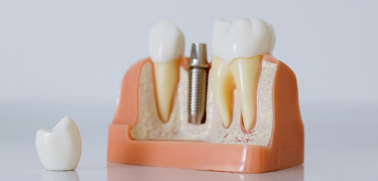 how long do dental implants last